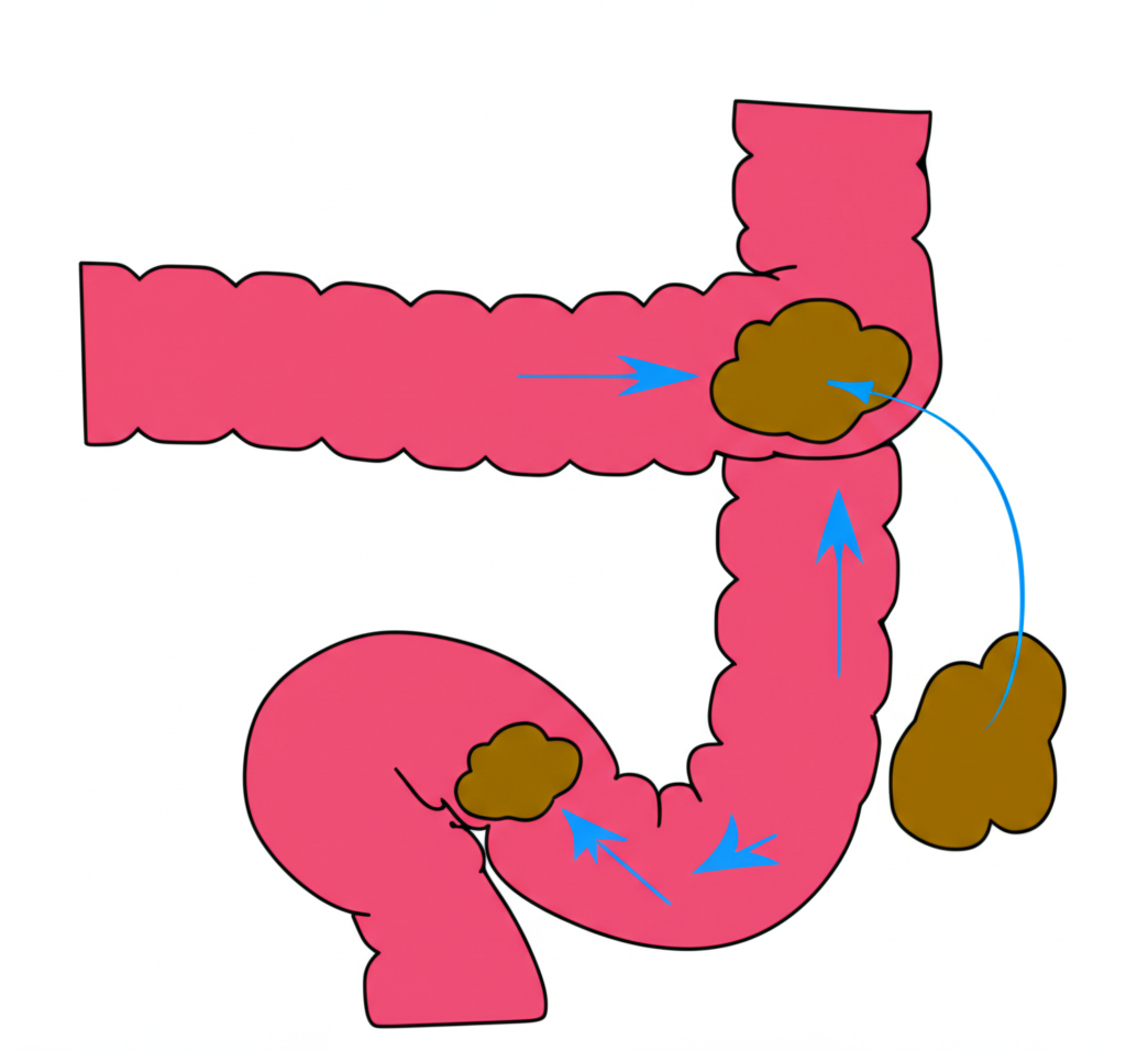 ภาพประกอบลำไส้ที่เรียบง่ายแสดงมาโครโกลดึงน้ำเข้าเพื่อทำให้อุจจาระนุ่มและขยายขนาดให้ขับถ่ายง่าย